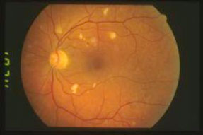 Microangiopatia-da-HIV 02