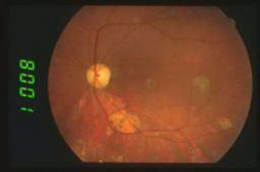 Retinocoroiditi-piu-rare