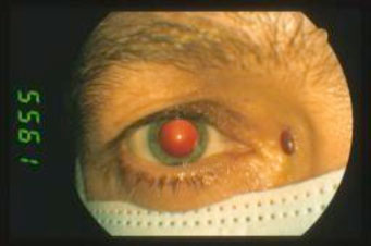 Sarcoma-di-Kaposi 01