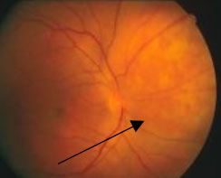 emangioma-della-coroide