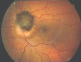 il-melanocitoma-uveale