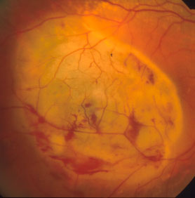 il-melanoma-uveale 03