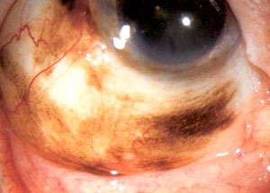melanoma-congiuntivale 01